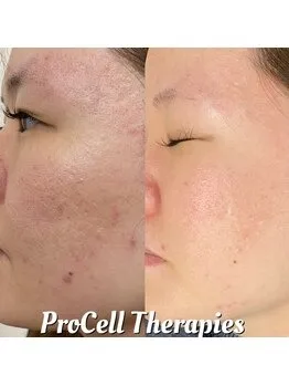プロセル肌質改善フェイシャル