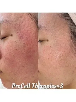 プロセル肌質改善トリートメント